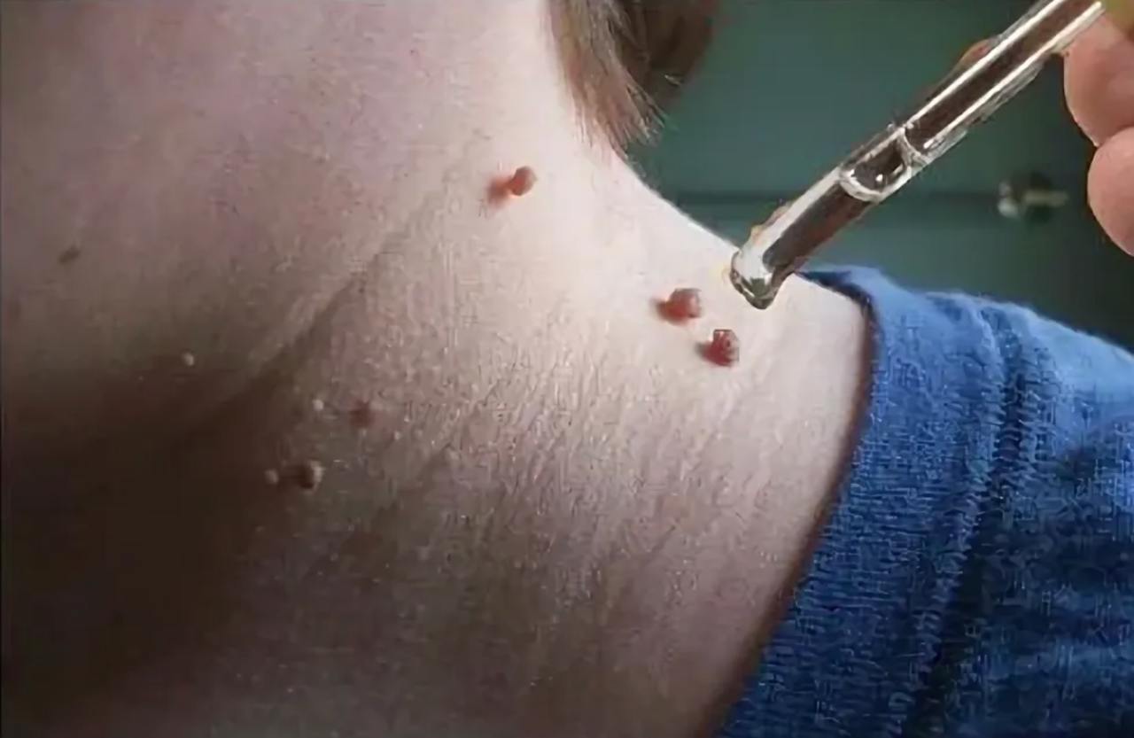 Parazitët intestinalë